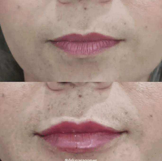 Preenchimento labial de outra paciente em close frontal: antes no alto, depois embaixo